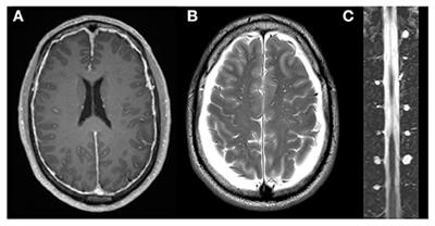 Spontaneous Intracranial Hypotension Without CSF Leakage—Concept of a Pathological Cranial to Spinal Fluid Shift